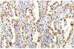 Immunohistochemistry (IHC) analyzes of STAT-5A antibody in paraffin-embedded human lung carcinoma tissue. (STAT5A anticorps)