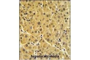 FBP1 Antibody (N-term) (ABIN391576 and ABIN2841511) IHC analysis in formalin fixed and paraffin embedded human hepatocarcinoma followed by peroxidase conjugation of the secondary antibody and DAB staining. (FBP1 anticorps  (N-Term))