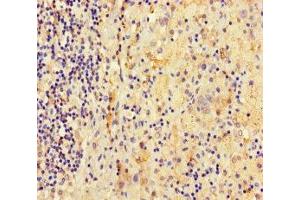 Immunohistochemistry of paraffin-embedded human lung cancer using ABIN7145044 at dilution of 1:100 (ATAD3C anticorps  (AA 1-122))
