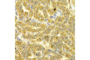 Immunohistochemistry of paraffin-embedded human thyroid cancer using DLD Antibody. (DLD anticorps  (AA 36-300))