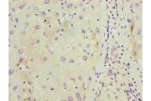 Immunohistochemistry of paraffin-embedded human liver cancer using ABIN7174715 at dilution of 1:100 (C11orf53 anticorps  (AA 13-236))