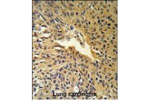 COG2 Antibody (N-term) (R) IHC analysis in formalin fixed and paraffin embedded human Lung carcinoma followed by peroxidase conjugation of the secondary antibody and DAB staining. (COG2 anticorps  (N-Term))