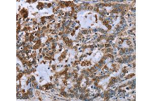 Immunohistochemistry of Human liver cancer using IMPDH2 Polyclonal Antibody at dilution of 1:60 (IMPDH2 anticorps)