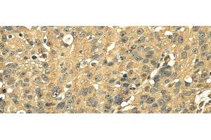Immunohistochemistry of paraffin-embedded Human breast cancer using RPS3 Polyclonal Antibody at dilution of 1/25