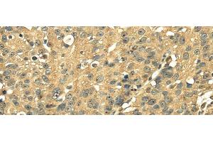 Immunohistochemistry of paraffin-embedded Human breast cancer using RPS3 Polyclonal Antibody at dilution of 1/25 (RPS3 anticorps)