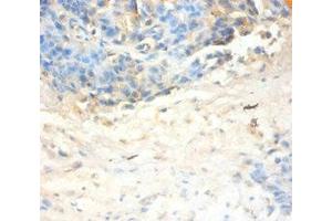 Immunohistochemistry of paraffin-embedded human ovarian cancer using ABIN7144333 at dilution of 1:100