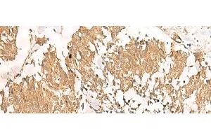 Immunohistochemistry of paraffin-embedded Human lung cancer tissue using MTHFD2L Polyclonal Antibody at dilution of 1:30(x200) (MTHFD2L anticorps)