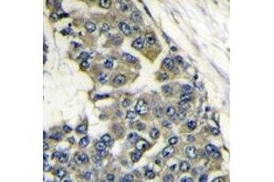 IHC analysis of FFPE human breast carcinoma stained with EIF4B antibody