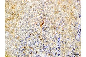 Formalin-fixed and paraffin embedded human endometrium carcinoma labeled with Rabbit Anti-Matriptase Polyclonal Antibody , Unconjugated at 1:100 followed by conjugation to the secondary antibody and DAB staining.