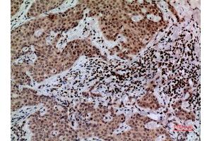 Immunohistochemistry (IHC) analysis of paraffin-embedded Human Mammary Cancer, antibody was diluted at 1:100. (CACYBP anticorps  (C-Term))