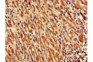 Immunohistochemistry of paraffin-embedded human liver cancer using ABIN7149048 at dilution of 1:100 (CRIPT anticorps  (AA 1-101))