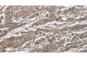 Immunohistochemistry of paraffin-embedded Human gastic cancer using IPO7 Polyclonal Antibody at dilution of 1:40 (IPO7 anticorps)