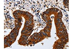 The image on the left is immunohistochemistry of paraffin-embedded Human colon cancer tissue using ABIN7130042(KRT23 Antibody) at dilution 1/20, on the right is treated with fusion protein.