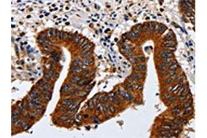 The image on the left is immunohistochemistry of paraffin-embedded Human colon cancer tissue using ABIN7130042(KRT23 Antibody) at dilution 1/20, on the right is treated with fusion protein. (KRT23 anticorps)
