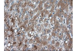 Immunohistochemical staining of paraffin-embedded Carcinoma of Human prostate tissue using anti-PANK2 mouse monoclonal antibody. (PANK2 anticorps)