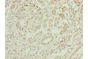 Immunohistochemistry of paraffin-embedded human pancreatic cancer using ABIN7152004 at dilution of 1:100