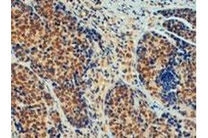 TRIM24 polyclonal antibody  (4 ug/mL) staining of paraffin embedded human breast cancer. (TRIM24 anticorps  (C-Term))