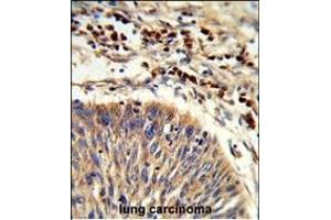 Formalin-fixed and paraffin-embedded human lung carcinoma reacted with HS Antibody (C-term), which was peroxidase-conjugated to the secondary antibody, followed by DAB staining.