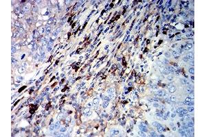 Immunohistochemical analysis of paraffin-embedded cervical cancer tissues using CD45R mouse mAb with DAB staining.