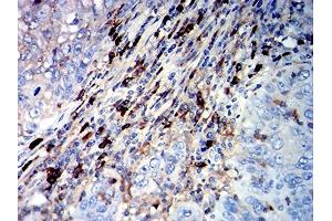 Immunohistochemical analysis of paraffin-embedded cervical cancer tissues using CD45R mouse mAb with DAB staining. (CD45 anticorps  (AA 378-577))
