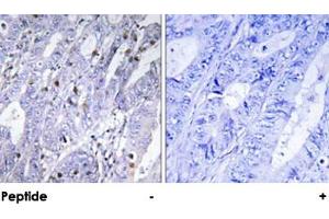 Immunohistochemical analysis of paraffin-embedded human colon carcinoma tissue using MEF2D polyclonal antibody . (MEF2D anticorps)