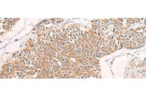 Immunohistochemistry of paraffin-embedded Human prost at e cancer tissue using C14orf2 Polyclonal Antibody at dilution of 1:60(x200) (C14orf2 anticorps)