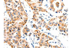 The image on the left is immunohistochemistry of paraffin-embedded Human lung cancer tissue using ABIN7191765(PAFAH1B1 Antibody) at dilution 1/25, on the right is treated with synthetic peptide.