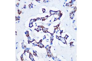 Immunohistochemistry of paraffin-embedded human thyroid cancer using CBS Rabbit mAb (ABIN7266615) at dilution of 1:100 (40x lens).