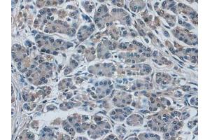 IHC-P analysis of Human Pancreas Cancer Tissue, with DAB staining. (IDE anticorps  (AA 753-973))