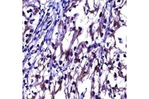 OPG antibody immunohistochemistry analysis in formalin fixed and paraffin embedded human kidney carcinoma. (Osteoprotegerin anticorps  (AA 243-271))