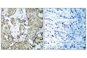 Immunohistochemical analysis of paraffin- embedded human breast carcinoma tissue, using MKK3 (phospho-Ser189) antibody (E011145). (MAP2K3 anticorps  (pSer189))