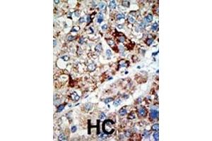 Formalin-fixed and paraffin-embedded human cancer tissue reacted with the primary antibody, which was peroxidase-conjugated to the secondary antibody, followed by AEC staining. (USP21 anticorps  (N-Term))
