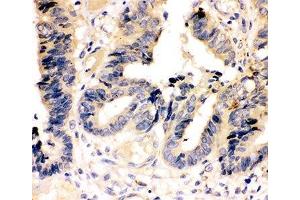 IHC-P: Caspase-7 antibody testing of human intestinal cancer tissue (Caspase 7 anticorps  (AA 237-255))