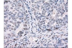 Immunohistochemical staining of paraffin-embedded Adenocarcinoma of colon tissue using anti-PPP5Cmouse monoclonal antibody. (PP5 anticorps)
