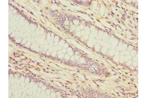 Immunohistochemistry of paraffin-embedded human colon cancer using ABIN7158367 at dilution of 1:100 (LMO4 anticorps  (AA 1-165))