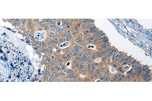 Immunohistochemistry of paraffin-embedded Human colorectal cancer tissue using RTN4IP1 Polyclonal Antibody at dilution of 1:50(x200) (RTN4IP1 anticorps)
