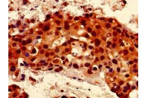 Immunohistochemistry of paraffin-embedded human breast cancer using ABIN7167078 at dilution of 1:100