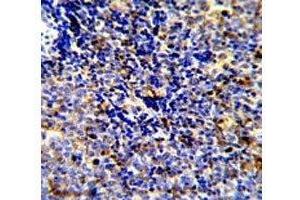 IHC analysis of FFPE human lymphoma stained with MERTK antibody (MERTK anticorps)