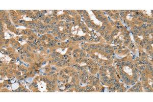 Immunohistochemistry of paraffin-embedded Human thyroid cancer using SEC14L2 Polyclonal Antibody at dilution of 1:40 (SEC14L2 anticorps)