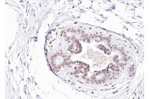 ABIN6267275 at 1/100 staining human Breast carcinoma tissue sections by IHC-P.