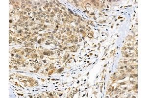 ABIN6260147 and ABIN6266767 at 1/100 staining Human pancreatic cancer by IHC-P. (ATRX anticorps  (N-Term))