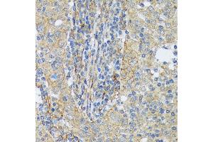 Immunohistochemistry of paraffin-embedded human esophageal cancer using Cortactin Rabbit mAb (ABIN7266511) at dilution of 1:100 (40x lens).