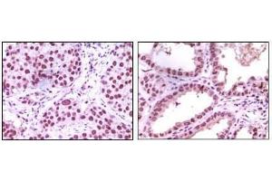 Immunohistochemical analysis of paraffin-embedded human lung carcinoma (left) and kidney carcinoma (right), showing nuclear localization using LSD1 antibody with DAB staining. (LSD1 anticorps)