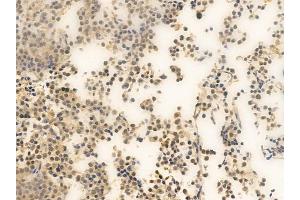 ABIN6262189 and ABIN6266560 at 1/100 staining human pituitary adenoma by IHC-P. (HDAC7 anticorps  (Internal Region))