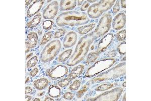Immunohistochemistry of paraffin-embedded human liver cancer using GAPDH Mouse mAb (ABIN3020540, ABIN3020541, ABIN3020542 and ABIN1512934) at dilution of 1:100 (40x lens). (GAPDH anticorps)
