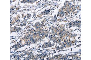 Immunohistochemistry of Human gastric cancer using CAPZA2 Polyclonal Antibody at dilution of 1:30 (CAPZA2 anticorps)