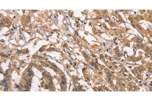 Immunohistochemistry of paraffin-embedded Human colon cancer using PEBP1 Polyclonal Antibody at dilution of 1:40