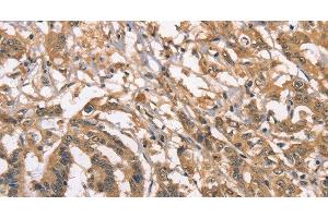 Immunohistochemistry of paraffin-embedded Human colon cancer using PEBP1 Polyclonal Antibody at dilution of 1:40 (PEBP1 anticorps)