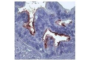 MMP1 in epithelial cells ovarian carcinoma was detected using HRP/DAB brown color stain. (MMP1 anticorps)