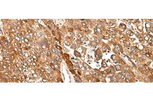 Immunohistochemistry of paraffin-embedded Human liver cancer tissue using CAD Polyclonal Antibody at dilution of 1:50(x200) (CAD anticorps)